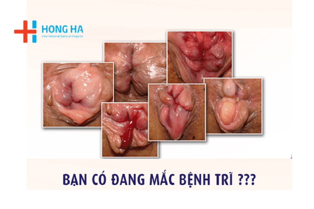 Dấu hiệu và nguyên nhân gây bệnh trĩ