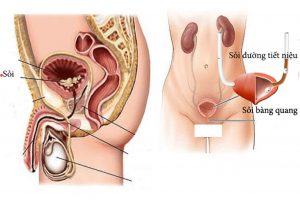 Sỏi bàng quang: Dấu hiệu, nguyên nhân và cách điều trị