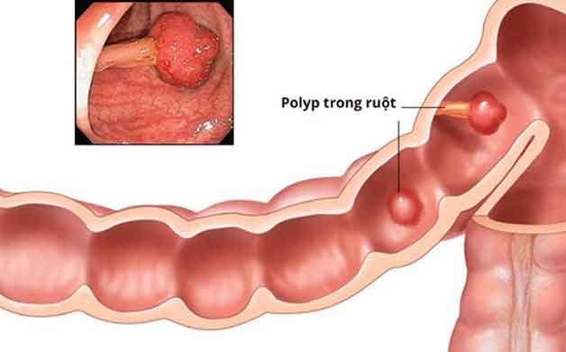 Bệnh polyp trực tràng là bệnh như thế nào