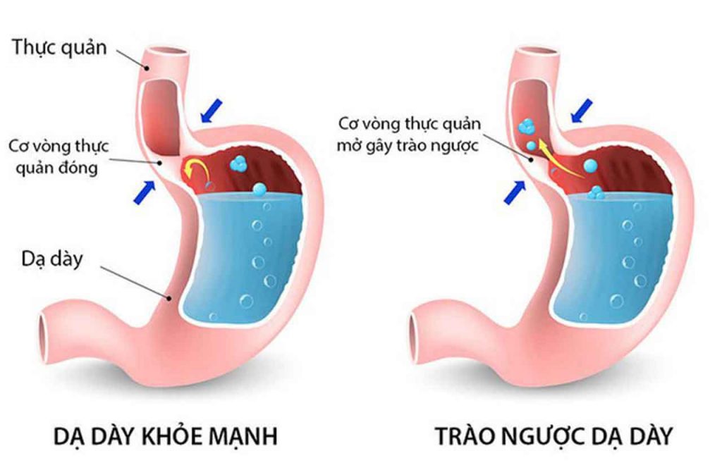 Trào Ngược Dạ Dày: Nguyên Nhân và Cách Điều Trị