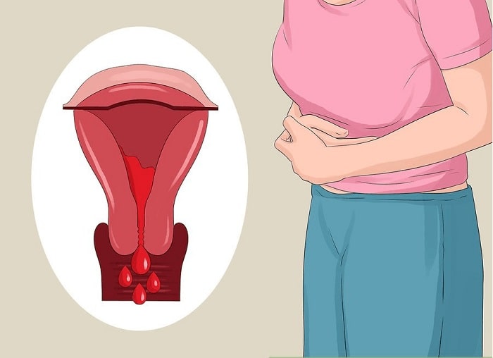 khám sức khỏe tổng quát vì có nhiều trường hợp không có các triệu chứng gì nhưng vẫn bị lạc nội mạc tử cung.