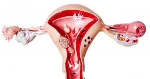 Lạc nội mạc tử cung là gì? Dấu hiệu nhận biết và cách điều trị