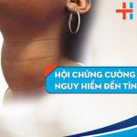 Nguy hiểm biến chứng bệnh cường giáp: Điều trị cách nào?
