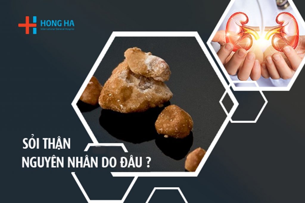 Những Nguyên Nhân Không Ngờ Gây Sỏi Thận