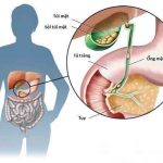 Triệu Chứng – Nguyên Nhân Hình Thành Sỏi Túi Mật
