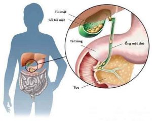 Triệu Chứng – Nguyên Nhân Hình Thành Sỏi Túi Mật