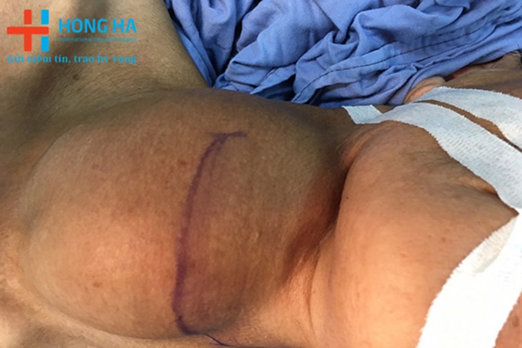 Phẫu thuật nội soi tuyến giáp công nghệ Plasma