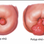 Polyp cổ tử cung là gì? Dấu hiệu nhận biết và cách điều trị dứt điểm