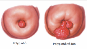 Polyp cổ tử cung là gì? Dấu hiệu nhận biết và cách điều trị dứt điểm
