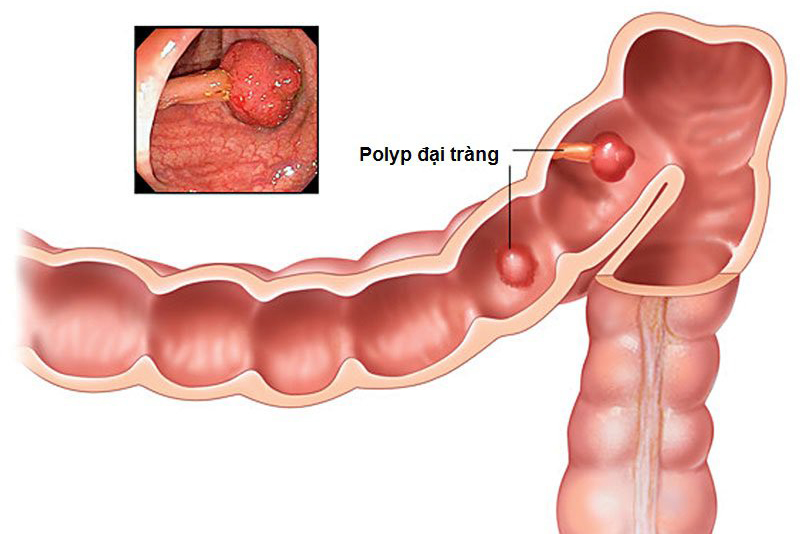 riệu chứng của polyp đại tràng