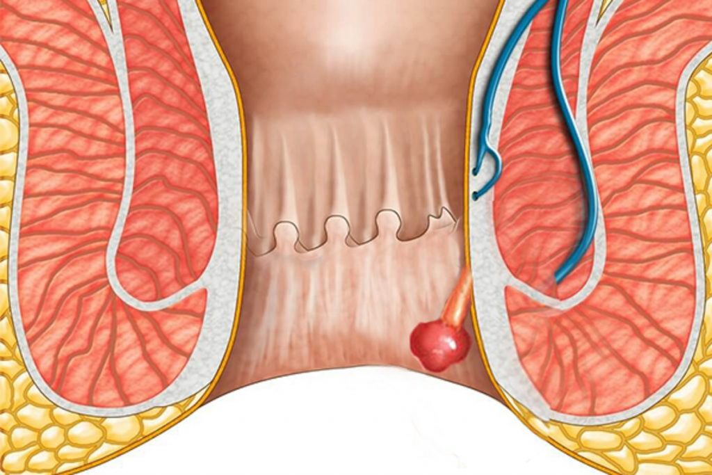 Polyp hậu môn: Dấu hiệu, nguyên nhân và cách điều trị.