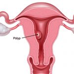 Polyp tử cung: Các phương pháp chẩn đoán và điều trị hiệu quả