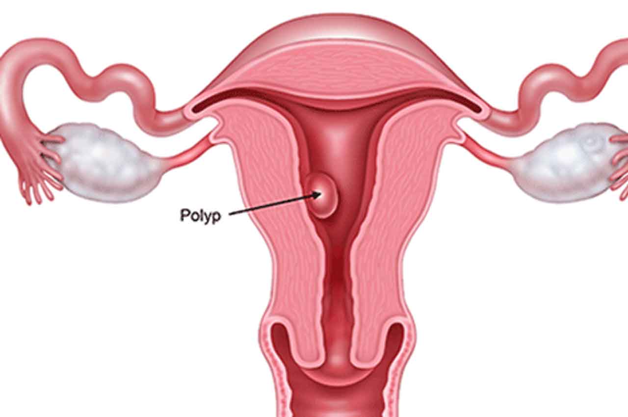 Polyp tử cung: Các phương pháp chẩn đoán và điều trị hiệu quả