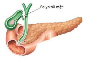 Polyp túi mật: Dấu hiệu, nguyên nhân và phương pháp điều trị