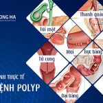 Polyp là gì ? Nguyên nhân, triệu chứng và cách điều