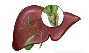 Sỏi gan: Phương pháp điều trị sỏi gan tốt nhất hiện nay