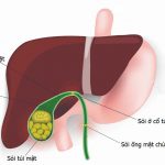 Sỏi túi mật: Đánh tan nỗi lo sỏi to, sỏi nhỏ