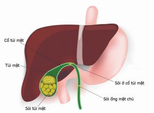 Sỏi túi mật: Đánh tan nỗi lo sỏi to, sỏi nhỏ