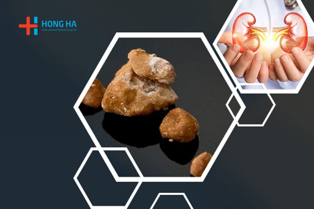 Kích thước sỏi thận bao nhiêu thì nguy hiểm