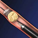 Tán sỏi qua da công nghệ LASER