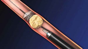 Tán sỏi qua da công nghệ LASER