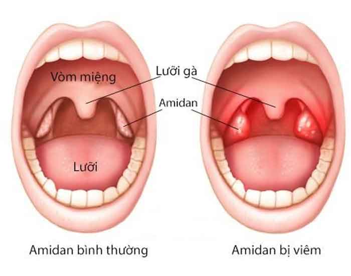 Viêm amidan quá phát : Dấu hiệu, nguyên nhân và phương pháp điều trị