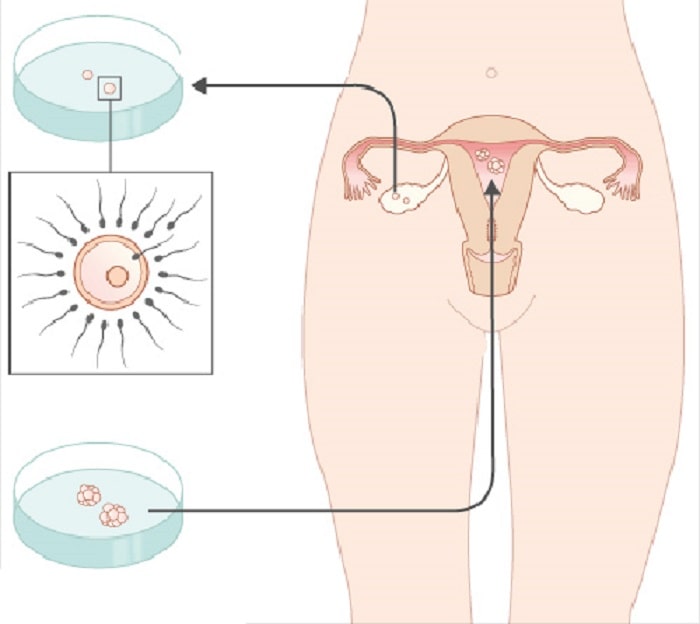 thụ tinh trong ống nghiệm IVF 