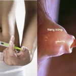 Tiêm thuốc rụng trứng khi nào, tăng khả năng thụ thai ở nữ giới