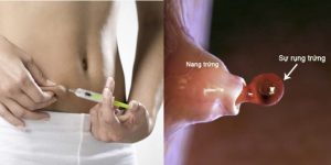 Tiêm thuốc rụng trứng khi nào, tăng khả năng thụ thai ở nữ giới