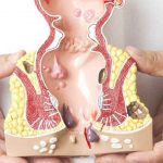 Trĩ nội: Dấu hiệu,nguyên nhân và cách điều trị