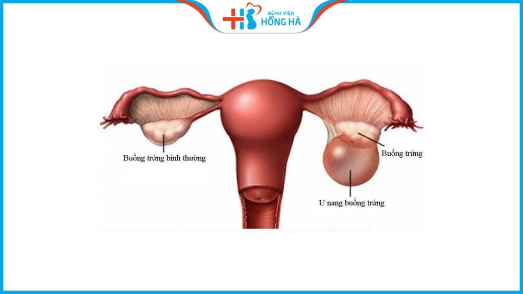 U nang buồng trứng: Tác động nguy hiểm đến sức khỏe của bạn