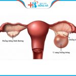 U nang buồng trứng: Tác động nguy hiểm đến sức khỏe của bạn