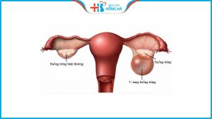 U nang buồng trứng: Tác động nguy hiểm đến sức khỏe của bạn