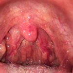 Viêm amidan mạn tính : Dấu hiệu, nguyên nhân và phương pháp điều trị