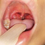 Viêm Amidan cấp tính: Dấu hiệu, nguyên nhân và phương pháp điều trị