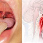 Viêm V.A cấp – Dấu hiệu, nguyên nhân và cách điều trị