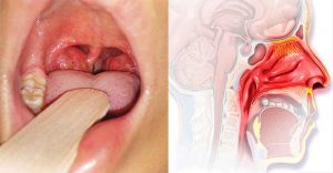 Viêm V.A cấp – Dấu hiệu, nguyên nhân và cách điều trị