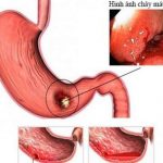 Xuất Huyết Dạ Dày: Dấu Hiệu, Nguyên Nhân và Cách Điều Trị
