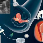 Thụ tinh nhân tạo như thế nào? Phương pháp này có thể dùng cho những ai?