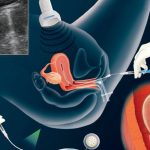 Quy trình lấy trứng thụ tinh ống nghiệm và chăm sóc sau khi làm