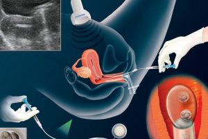 Quy trình lấy trứng thụ tinh ống nghiệm và chăm sóc sau khi làm