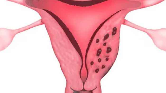 Căn bệnh lạc nội mạc tử cung đang dần trở nên phổ biến ở phụ nữ