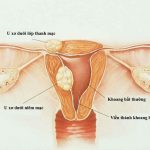 Top 5+ bệnh phụ khoa dễ gây vô sinh nữ? Bệnh nào đáng sợ nhất