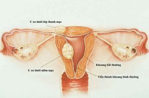 Top 5+ bệnh phụ khoa dễ gây vô sinh nữ? Bệnh nào đáng sợ nhất