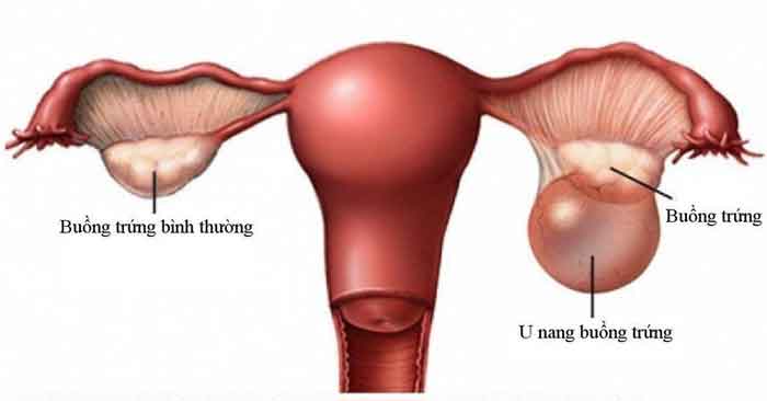Căn bệnh u nang buồng trứng khiến nhiều phụ nữ vô sinh