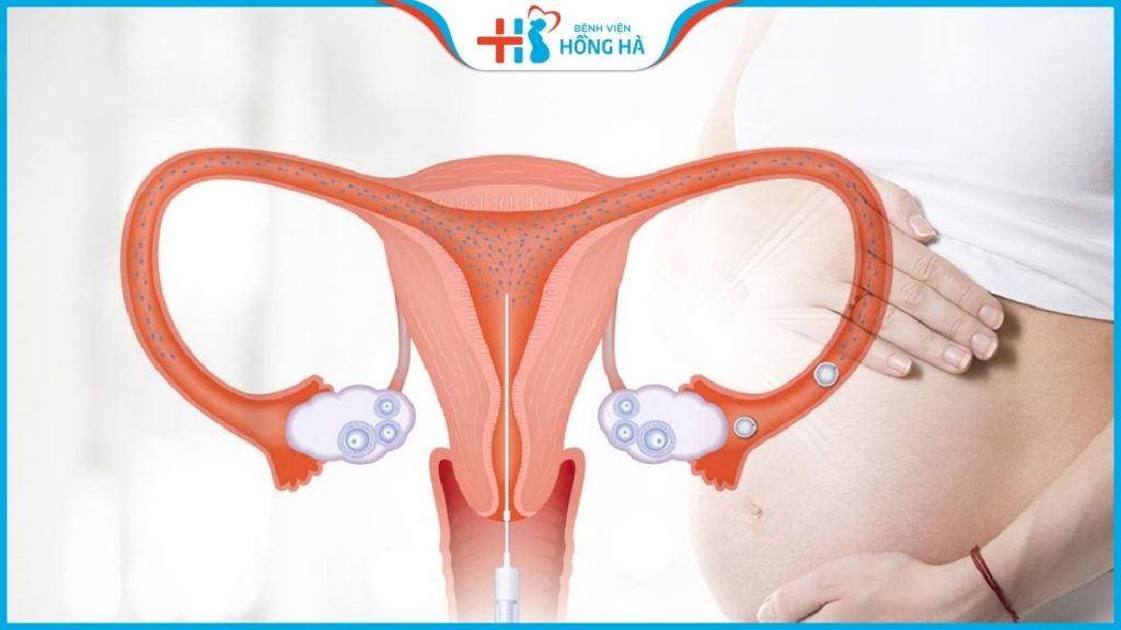 Góc thắc mắc của nhiều vợ chồng hiếm muộn: Chi phí bơm tinh trùng