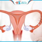 Góc thắc mắc của nhiều vợ chồng hiếm muộn: Chi phí bơm tinh trùng