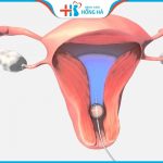 Bơm tinh trùng tại nhà có được không? 6 yếu tố làm tăng tỷ lệ thành công