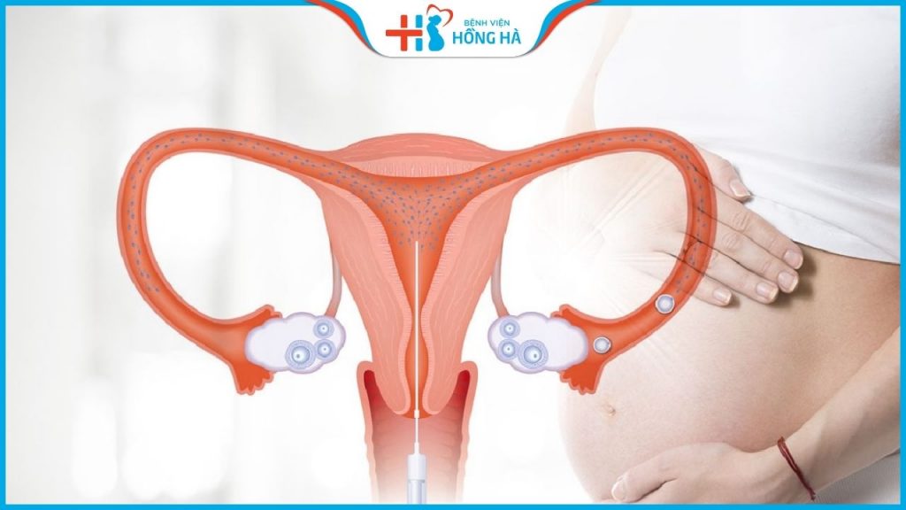 5 điều cần làm sau khi bơm tinh trùng giúp giữ thai khỏe mạnh