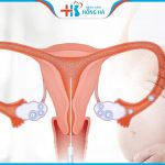 5 điều cần làm sau khi bơm tinh trùng giúp giữ thai khỏe mạnh